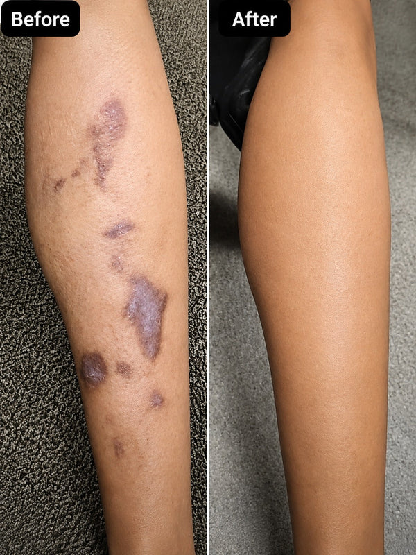 RenewGuard Advanced Scar Softening System